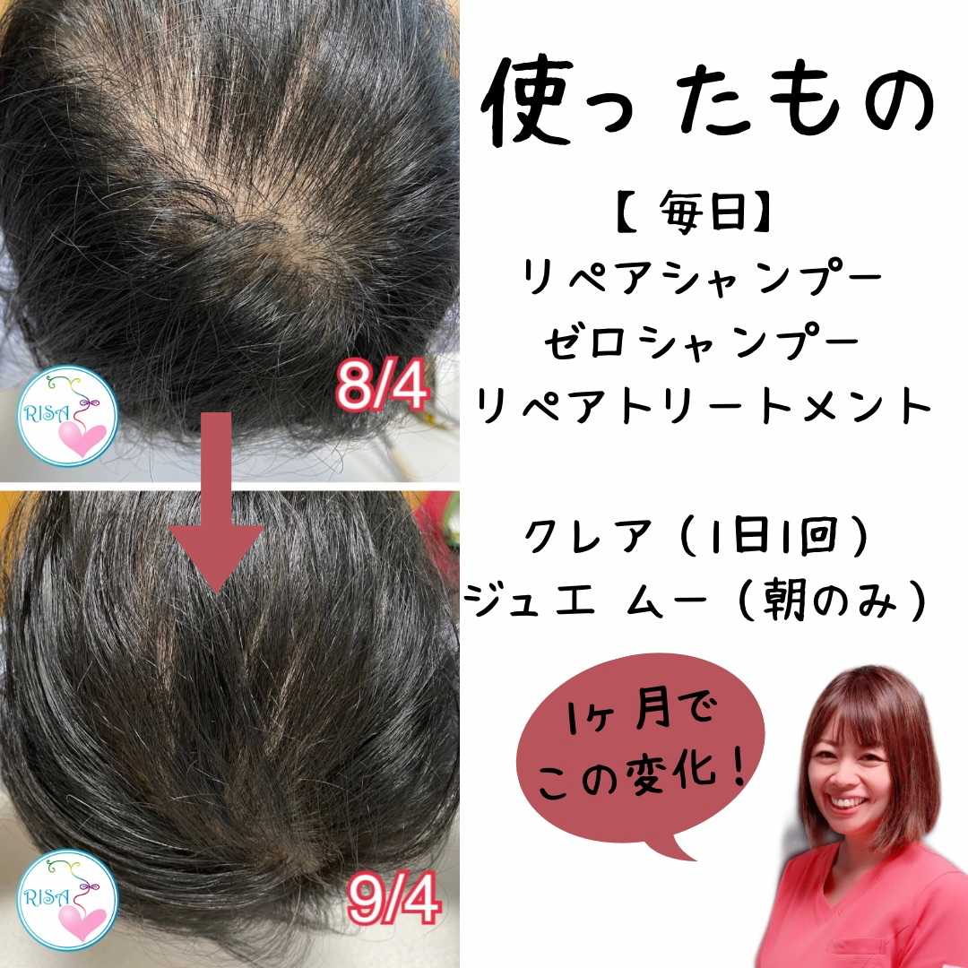 抜け毛・薄毛】強髪シャンプー使ってみたら、患者様からの口コミがまじ